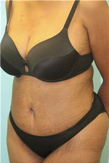 Tummy Tuck After Photo by Keyian Paydar, MD, FACS; Newport Beach, CA - Case 46897