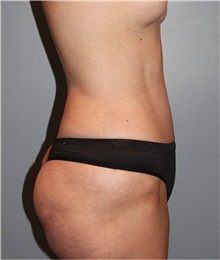 Tummy Tuck After Photo by Keyian Paydar, MD, FACS; Newport Beach, CA - Case 46898