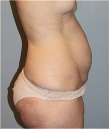 Tummy Tuck Before Photo by Keyian Paydar, MD, FACS; Newport Beach, CA - Case 46898
