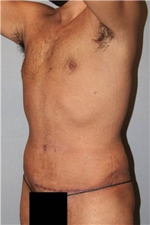 Tummy Tuck After Photo by Keyian Paydar, MD, FACS; Newport Beach, CA - Case 46899