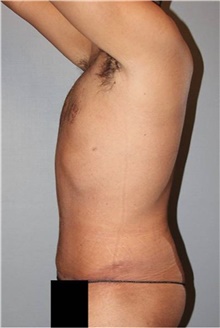 Tummy Tuck After Photo by Keyian Paydar, MD, FACS; Newport Beach, CA - Case 46899