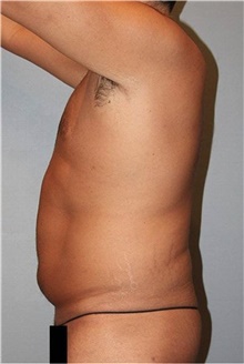 Tummy Tuck Before Photo by Keyian Paydar, MD, FACS; Newport Beach, CA - Case 46899