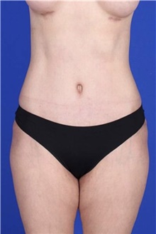 Tummy Tuck After Photo by Keyian Paydar, MD, FACS; Newport Beach, CA - Case 46900