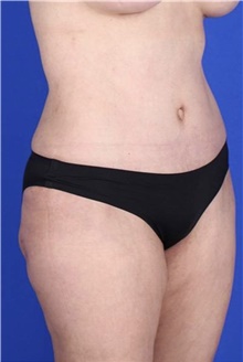 Tummy Tuck After Photo by Keyian Paydar, MD, FACS; Newport Beach, CA - Case 46900