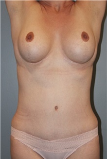 Tummy Tuck After Photo by Keyian Paydar, MD, FACS; Newport Beach, CA - Case 46901