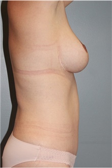 Tummy Tuck After Photo by Keyian Paydar, MD, FACS; Newport Beach, CA - Case 46901