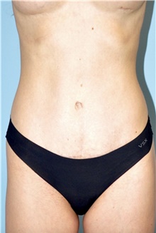 Tummy Tuck After Photo by Keyian Paydar, MD, FACS; Newport Beach, CA - Case 46902