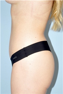 Tummy Tuck After Photo by Keyian Paydar, MD, FACS; Newport Beach, CA - Case 46902