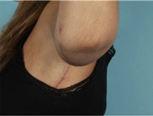 Arm Lift After Photo by Keyian Paydar, MD, FACS; Newport Beach, CA - Case 46909