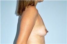 Breast Augmentation Before Photo by Keyian Paydar, MD, FACS; Newport Beach, CA - Case 46916