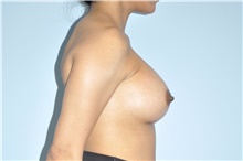 Breast Augmentation After Photo by Keyian Paydar, MD, FACS; Newport Beach, CA - Case 46917