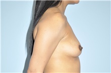 Breast Augmentation Before Photo by Keyian Paydar, MD, FACS; Newport Beach, CA - Case 46917