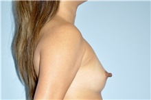 Breast Augmentation Before Photo by Keyian Paydar, MD, FACS; Newport Beach, CA - Case 46918