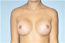 Breast Augmentation After Photo by Keyian Paydar, MD, FACS; Newport Beach, CA - Case 46920