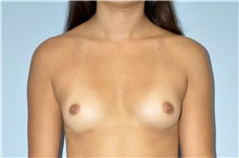 Breast Augmentation Before Photo by Keyian Paydar, MD, FACS; Newport Beach, CA - Case 46920