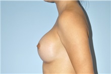 Breast Augmentation After Photo by Keyian Paydar, MD, FACS; Newport Beach, CA - Case 46920