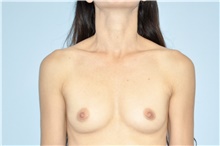 Breast Augmentation Before Photo by Keyian Paydar, MD, FACS; Newport Beach, CA - Case 46921