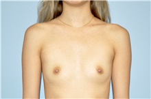 Breast Augmentation Before Photo by Keyian Paydar, MD, FACS; Newport Beach, CA - Case 46922