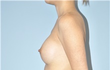 Breast Augmentation After Photo by Keyian Paydar, MD, FACS; Newport Beach, CA - Case 46922