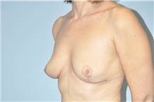 Breast Reduction After Photo by Keyian Paydar, MD, FACS; Newport Beach, CA - Case 46927