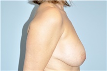 Breast Reduction Before Photo by Keyian Paydar, MD, FACS; Newport Beach, CA - Case 46927