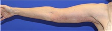 Arm Lift After Photo by Keyian Paydar, MD, FACS; Newport Beach, CA - Case 46964
