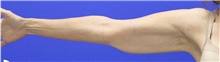 Arm Lift Before Photo by Keyian Paydar, MD, FACS; Newport Beach, CA - Case 46964