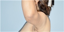 Arm Lift After Photo by Keyian Paydar, MD, FACS; Newport Beach, CA - Case 46969