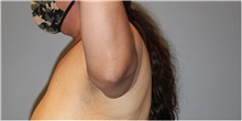 Arm Lift Before Photo by Keyian Paydar, MD, FACS; Newport Beach, CA - Case 46969