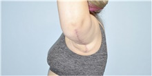 Arm Lift After Photo by Keyian Paydar, MD, FACS; Newport Beach, CA - Case 46971