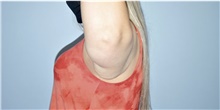 Arm Lift Before Photo by Keyian Paydar, MD, FACS; Newport Beach, CA - Case 46971