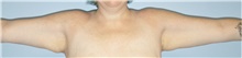 Arm Lift Before Photo by Keyian Paydar, MD, FACS; Newport Beach, CA - Case 46972