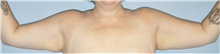 Arm Lift Before Photo by Keyian Paydar, MD, FACS; Newport Beach, CA - Case 46972