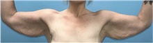 Arm Lift Before Photo by Keyian Paydar, MD, FACS; Newport Beach, CA - Case 46986
