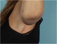 Arm Lift After Photo by Keyian Paydar, MD, FACS; Newport Beach, CA - Case 46988