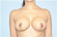 Breast Implant Revision After Photo by Keyian Paydar, MD, FACS; Newport Beach, CA - Case 46989