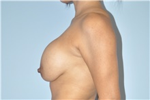 Breast Implant Revision Before Photo by Keyian Paydar, MD, FACS; Newport Beach, CA - Case 46989