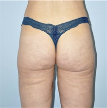 Thigh Lift After Photo by Keyian Paydar, MD, FACS; Newport Beach, CA - Case 46990