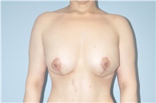 Breast Lift After Photo by Keyian Paydar, MD, FACS; Newport Beach, CA - Case 47128