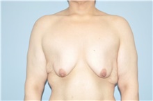 Breast Lift Before Photo by Keyian Paydar, MD, FACS; Newport Beach, CA - Case 47128