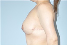 Breast Lift After Photo by Keyian Paydar, MD, FACS; Newport Beach, CA - Case 47128