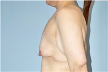 Breast Lift Before Photo by Keyian Paydar, MD, FACS; Newport Beach, CA - Case 47128