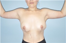 Arm Lift After Photo by Keyian Paydar, MD, FACS; Newport Beach, CA - Case 47129