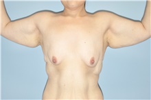 Arm Lift Before Photo by Keyian Paydar, MD, FACS; Newport Beach, CA - Case 47129