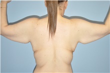 Arm Lift Before Photo by Keyian Paydar, MD, FACS; Newport Beach, CA - Case 47129