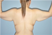 Back Lift (Upper Body Lift) Before and After Pictures Case 11677, Golden,  CO