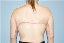 Body Lift After Photo by Keyian Paydar, MD, FACS; Newport Beach, CA - Case 47130