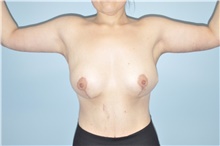 Body Lift After Photo by Keyian Paydar, MD, FACS; Newport Beach, CA - Case 47130