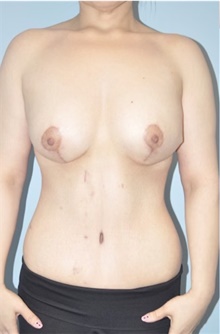 Tummy Tuck After Photo by Keyian Paydar, MD, FACS; Newport Beach, CA - Case 47131