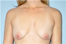 Breast Lift Before Photo by Keyian Paydar, MD, FACS; Newport Beach, CA - Case 47139